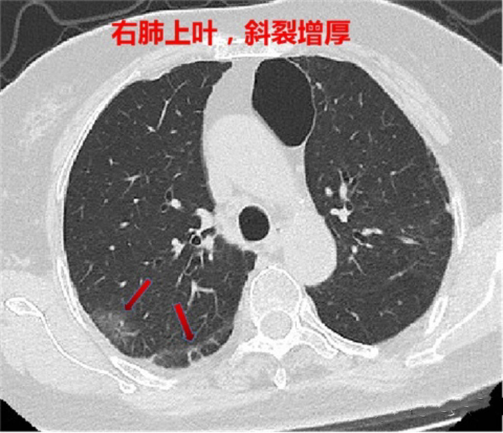新冠肺炎最新形势︰(肺膜炎是大病还是小病)-第2张图片